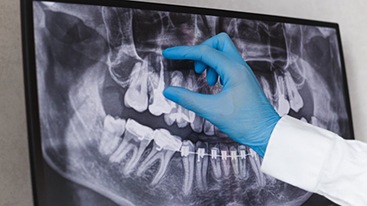 Dentist pointing at an X-ray