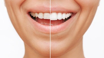 Closeup of someone’s smile that’s split in half to show before/after cosmetic dentistry