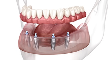 Rendering of implant dentures in a transparent jaw with a white background