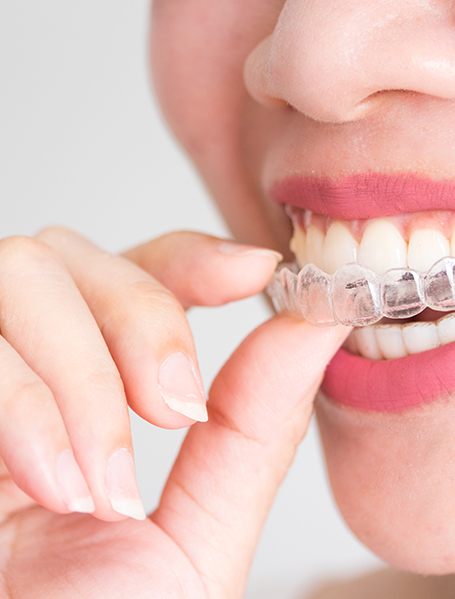 Smiling woman putting on clear aligner