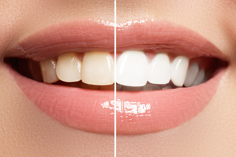 Patient smiling after teeth whitening